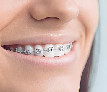 braces Legacy Dental Care Home
