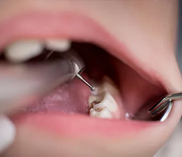 filling Legacy Dental Care Home