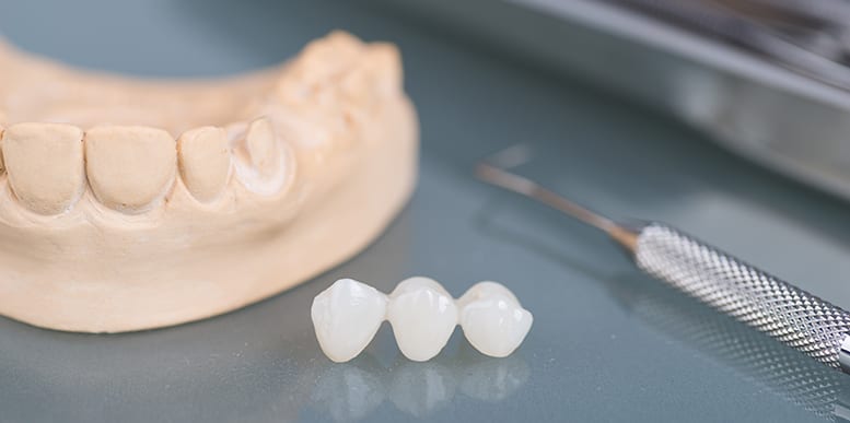 dental bridge Legacy Dental Care Bridges