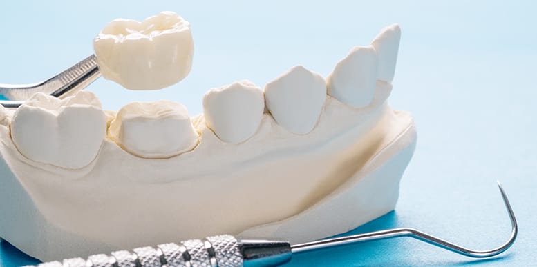 dental crown Legacy Dental Care Crowns