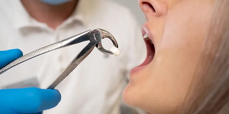 tooth extraction title Legacy Dental Care Tooth Extractions