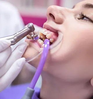 scale polish Legacy Dental Care Home